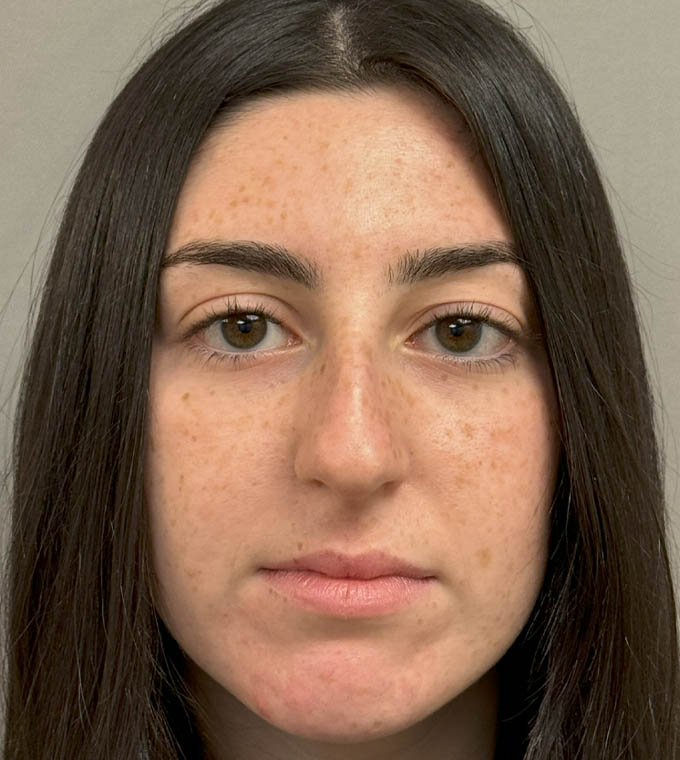 Rhinoplasty
