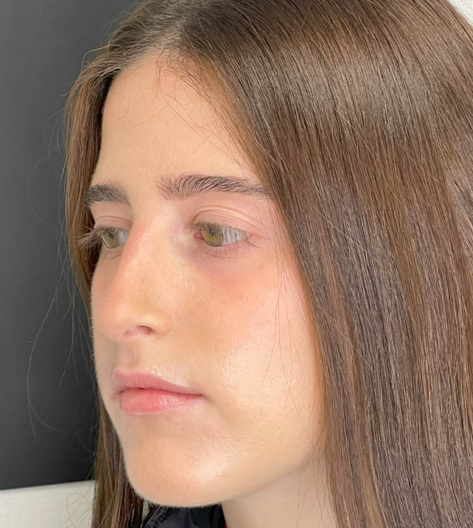 Rhinoplasty
