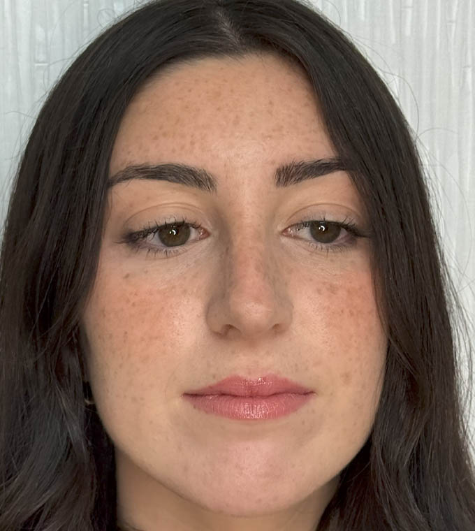 Rhinoplasty