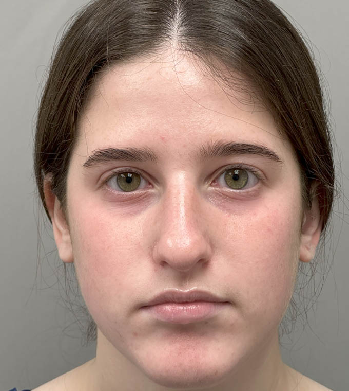 Rhinoplasty
