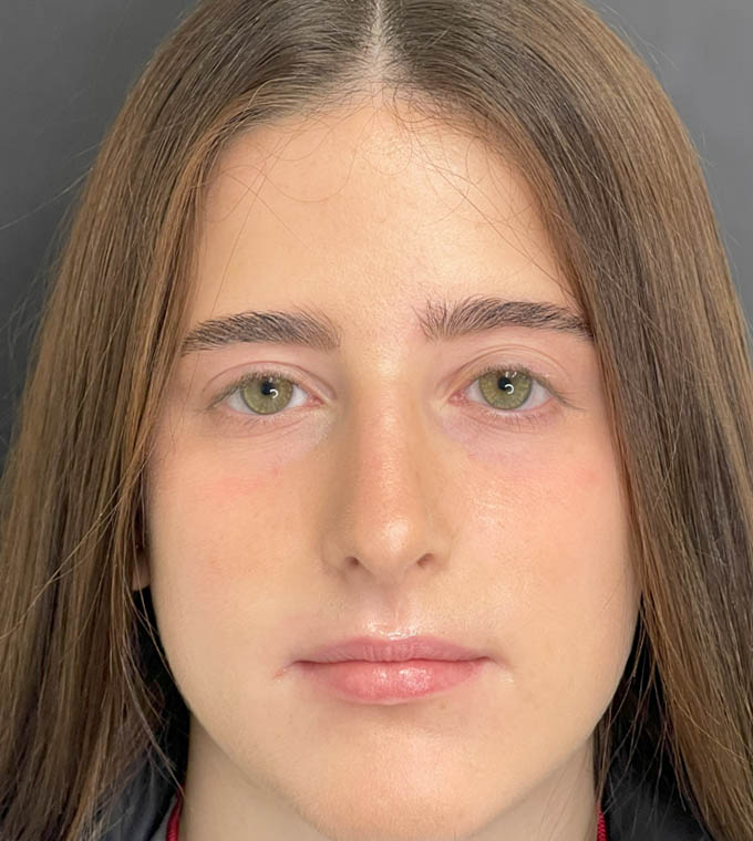Rhinoplasty