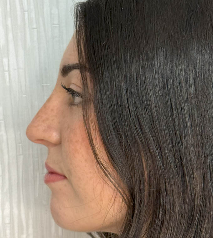 Rhinoplasty