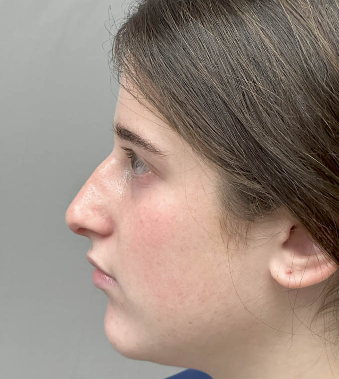 Rhinoplasty