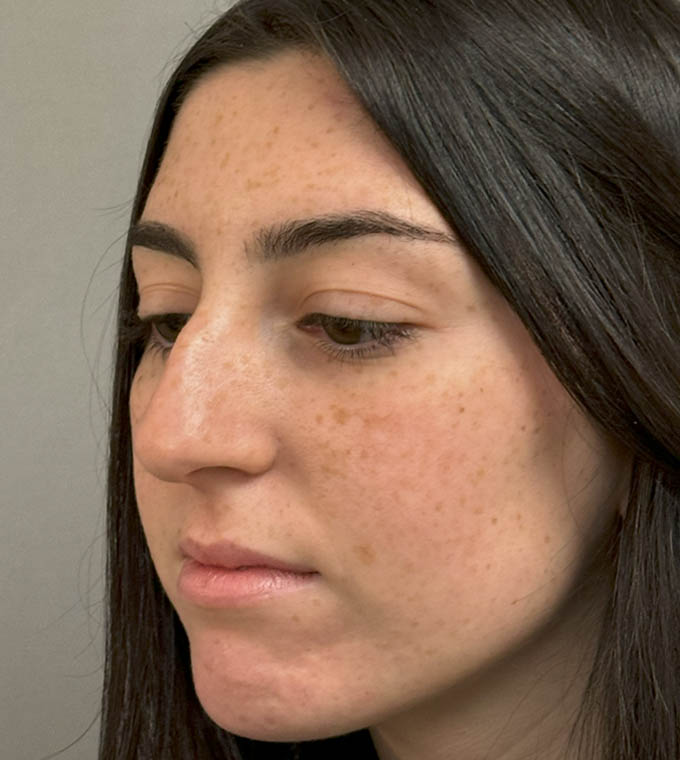 Rhinoplasty