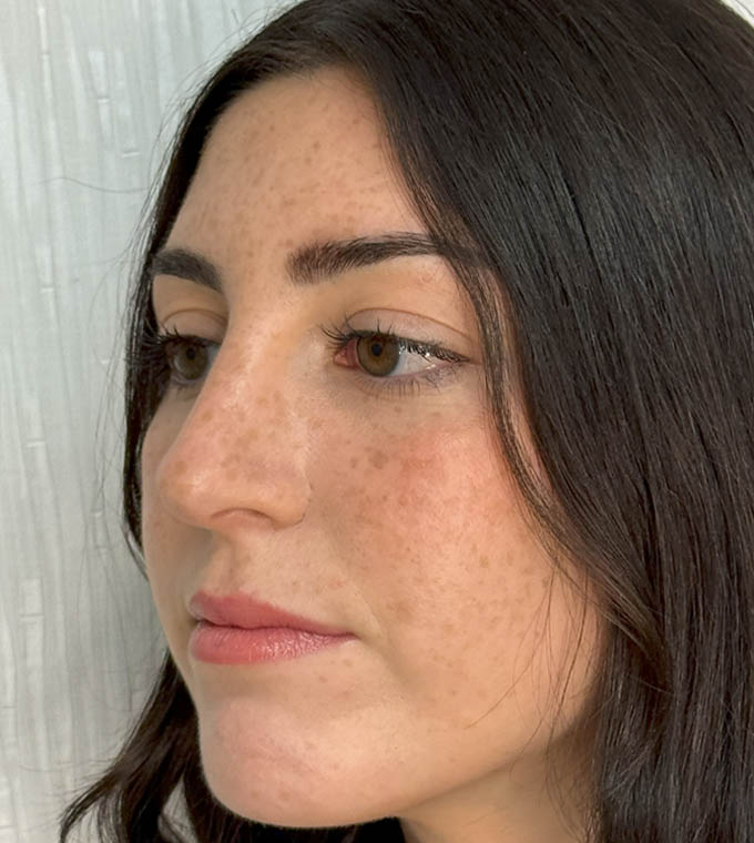 Rhinoplasty