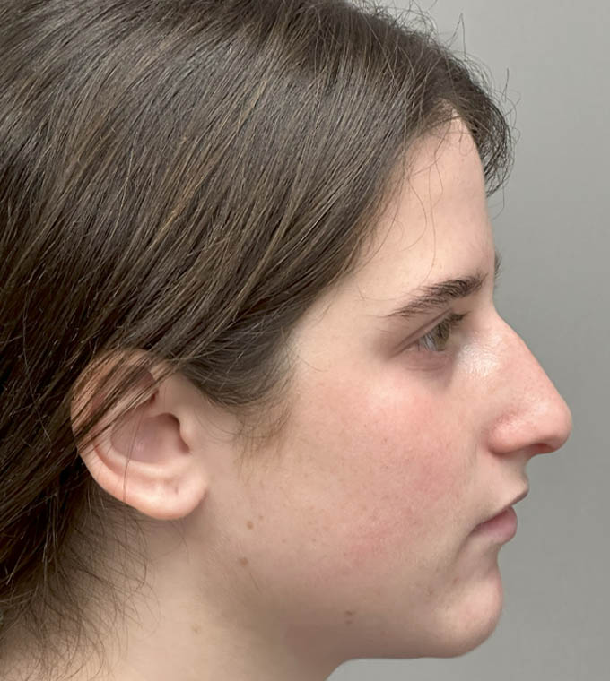 Rhinoplasty