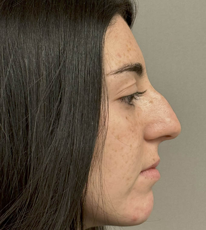 Rhinoplasty
