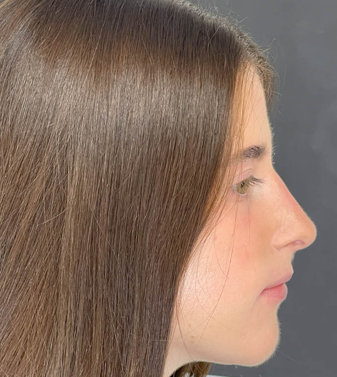 Rhinoplasty