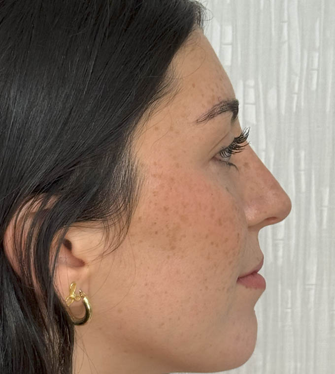 Rhinoplasty