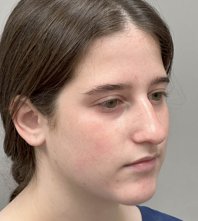 Rhinoplasty