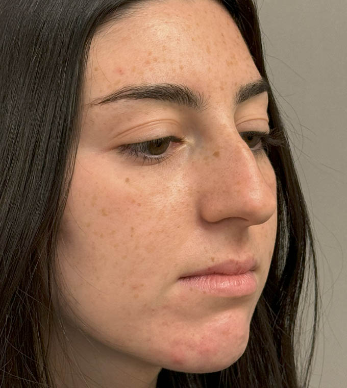 Rhinoplasty