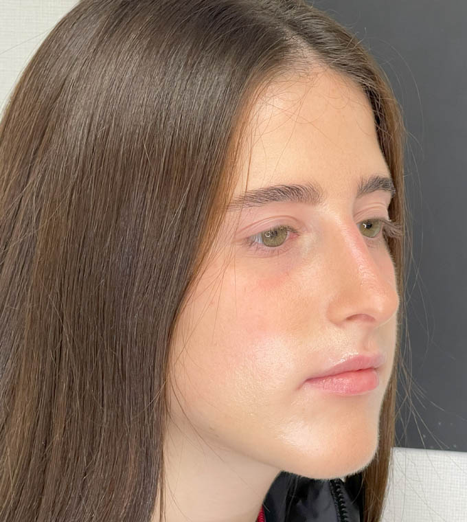 Rhinoplasty