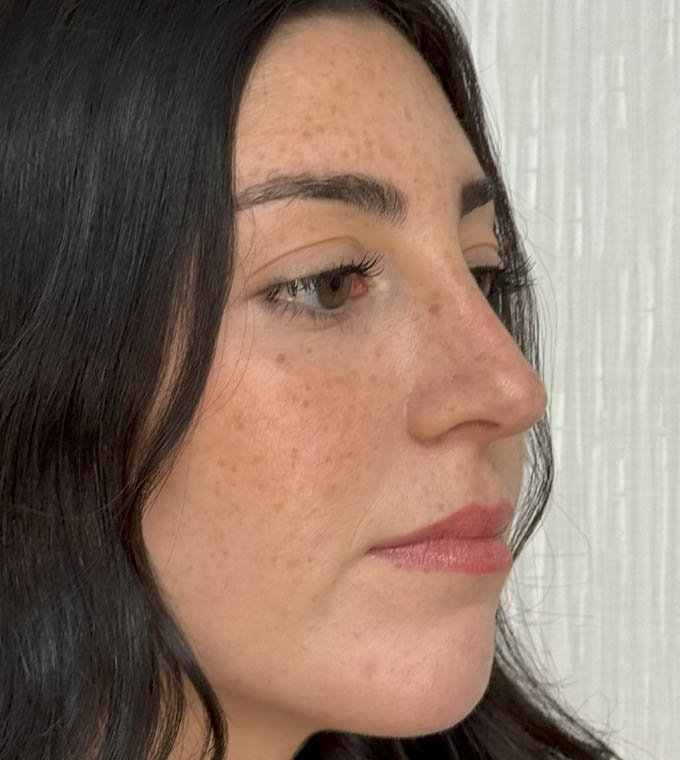 Rhinoplasty