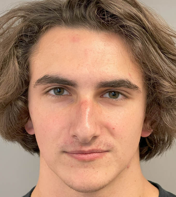 Rhinoplasty