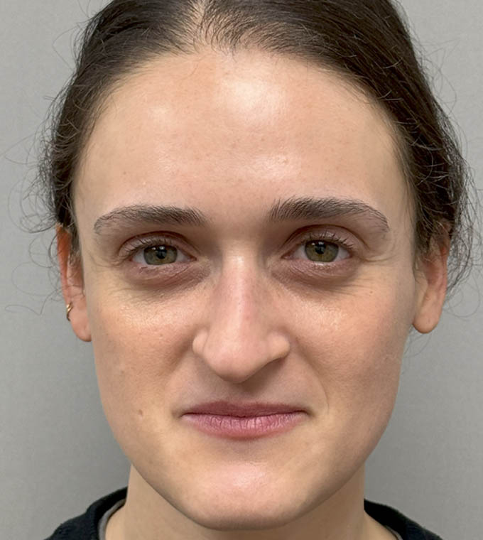 Rhinoplasty
