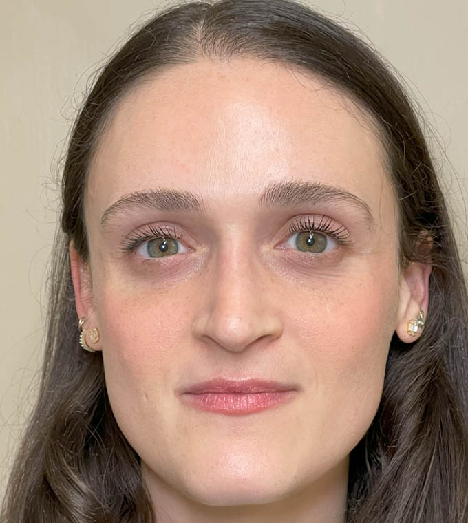 Rhinoplasty