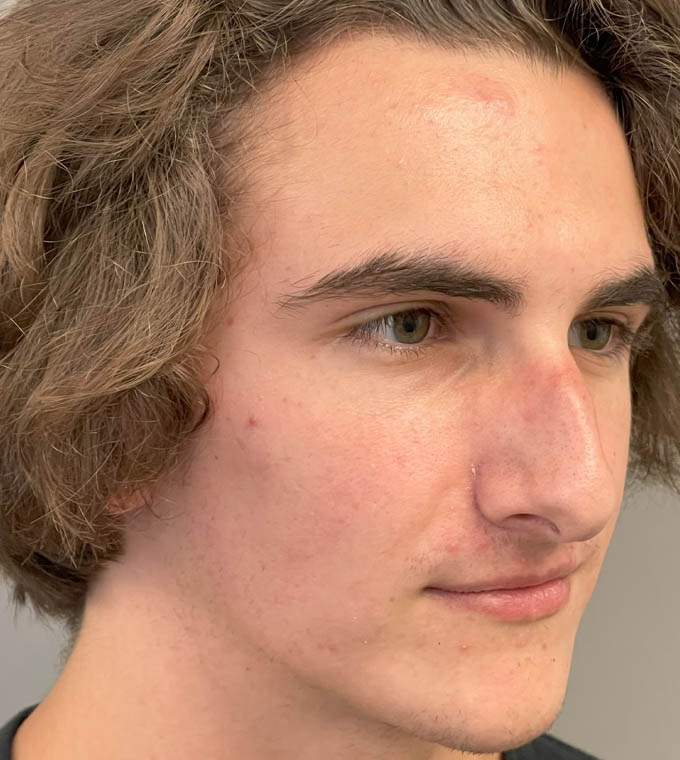 Rhinoplasty