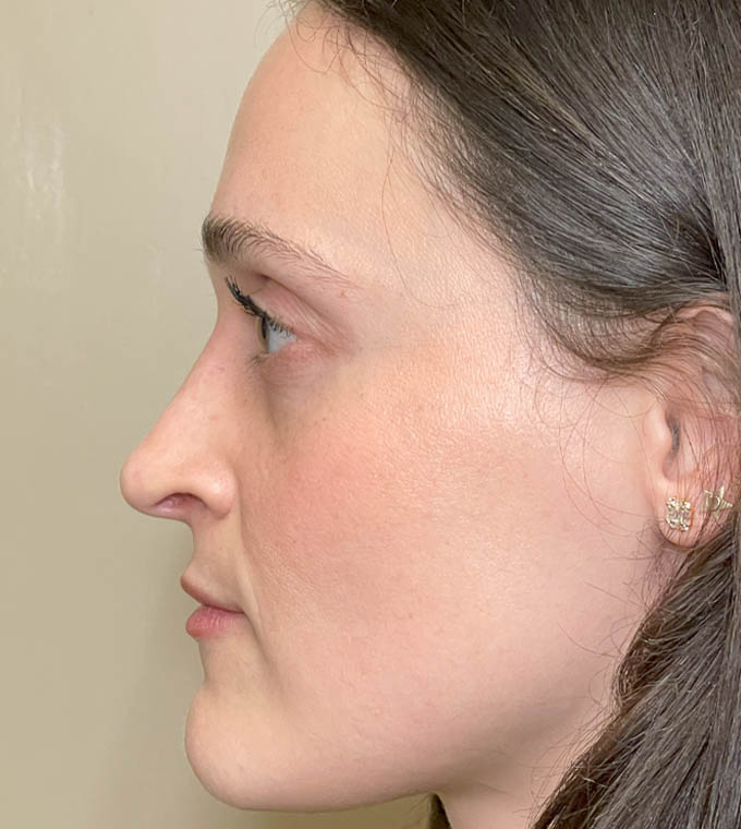 Rhinoplasty