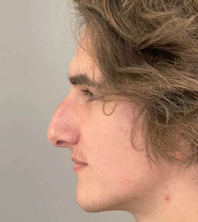 Rhinoplasty
