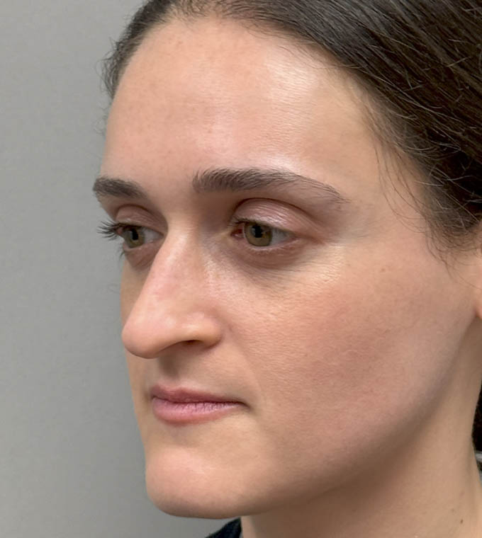 Rhinoplasty