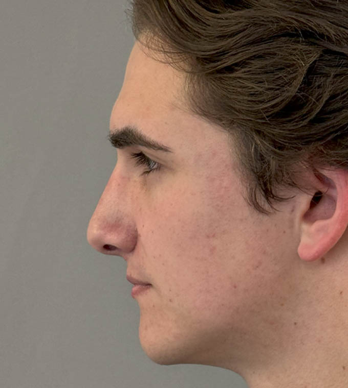 Rhinoplasty