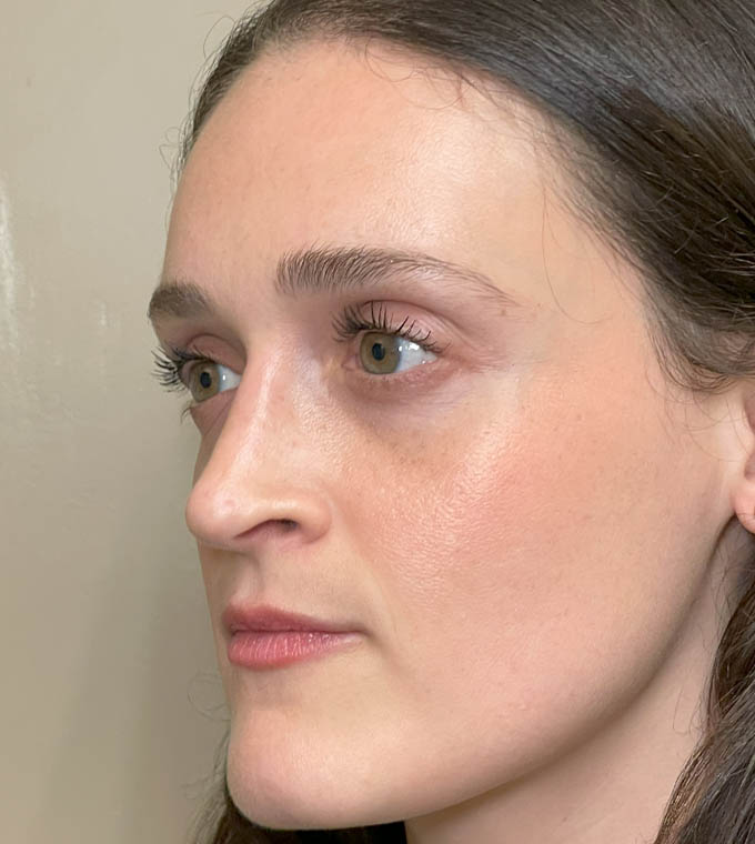 Rhinoplasty