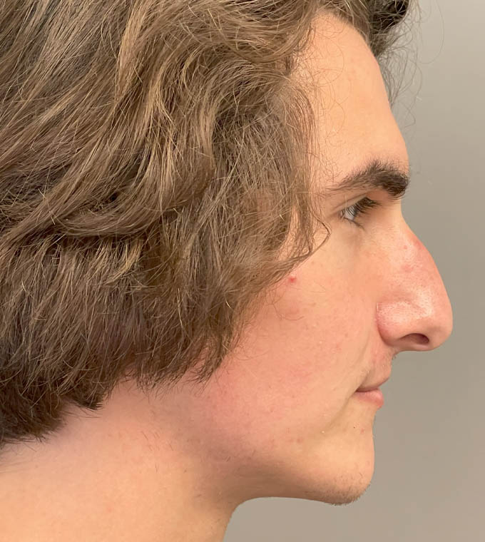 Rhinoplasty
