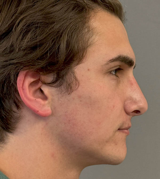 Rhinoplasty