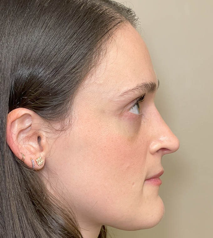 Rhinoplasty