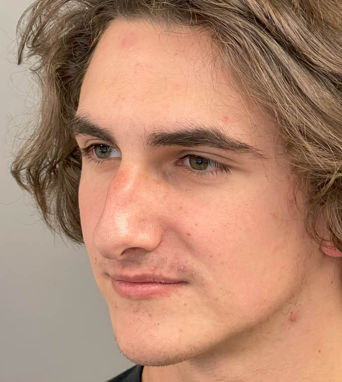 Rhinoplasty