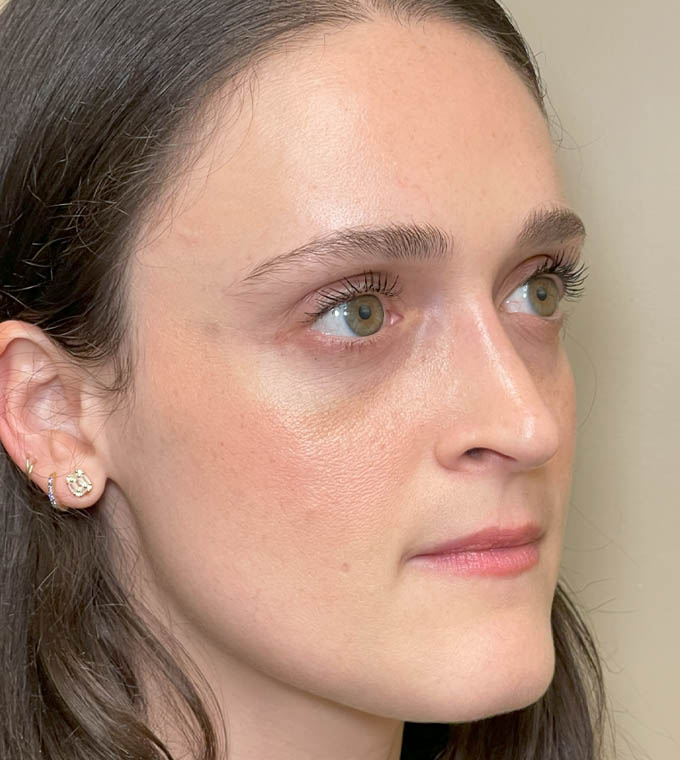 Rhinoplasty
