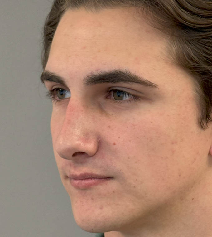 Rhinoplasty