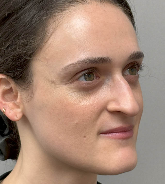 Rhinoplasty