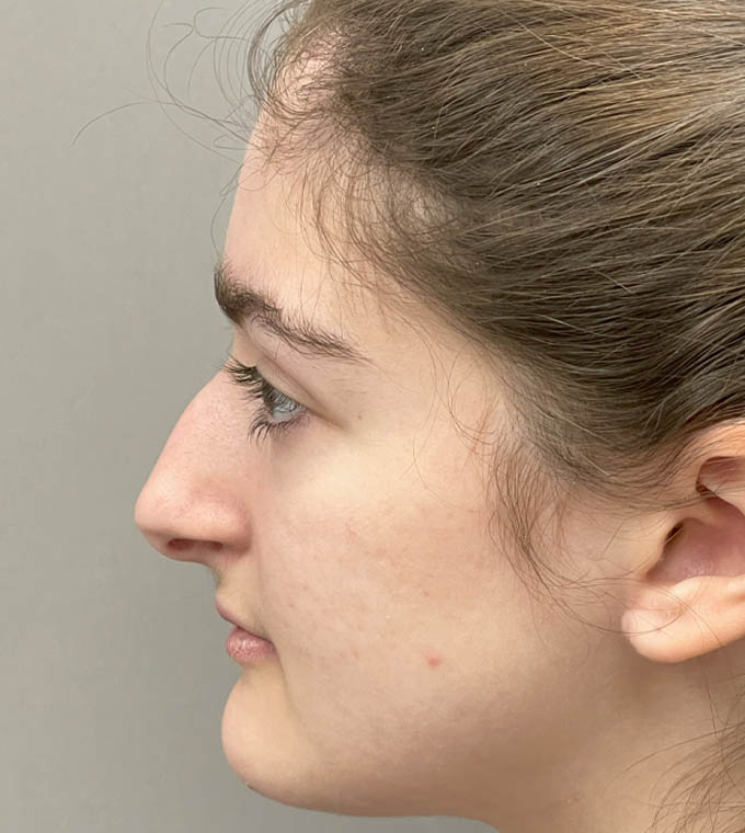 Rhinoplasty