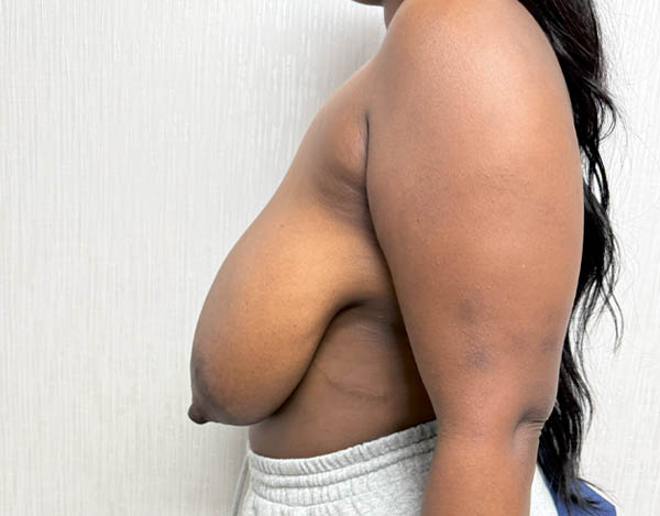 Breast Reduction