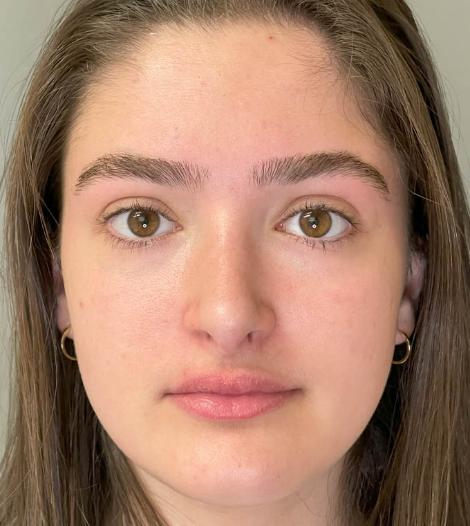 Rhinoplasty