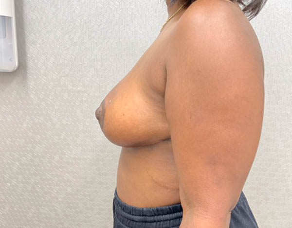Breast Reduction