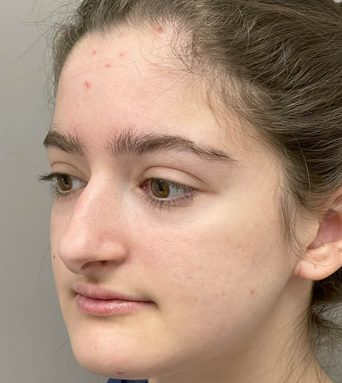 Rhinoplasty