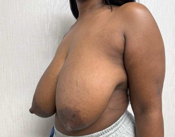 Breast Reduction
