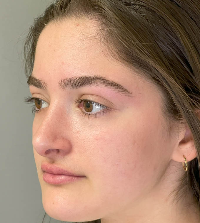 Rhinoplasty