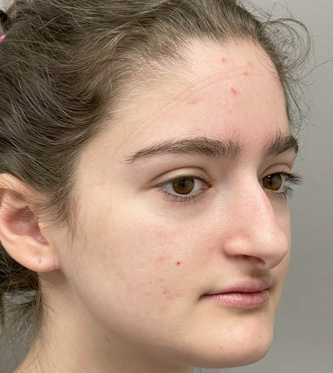 Rhinoplasty