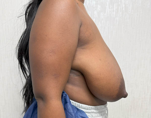 Breast Reduction