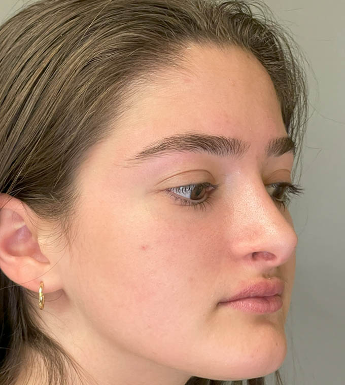 Rhinoplasty