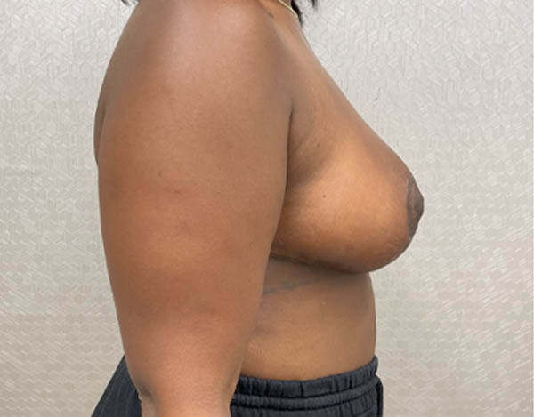 Breast Reduction