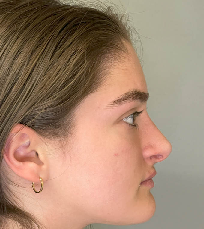 Rhinoplasty