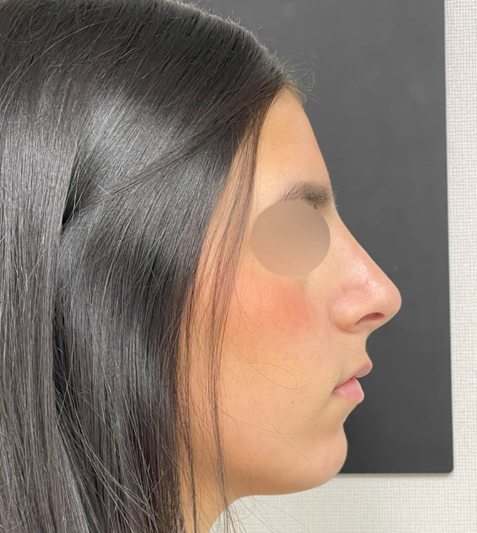 Rhinoplasty