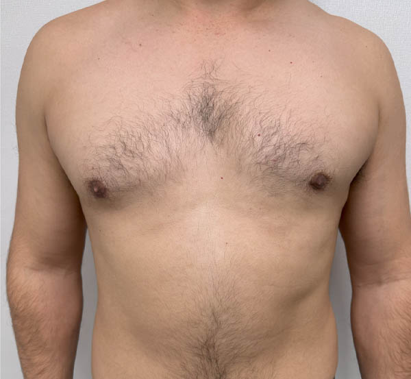 Gynecomastia