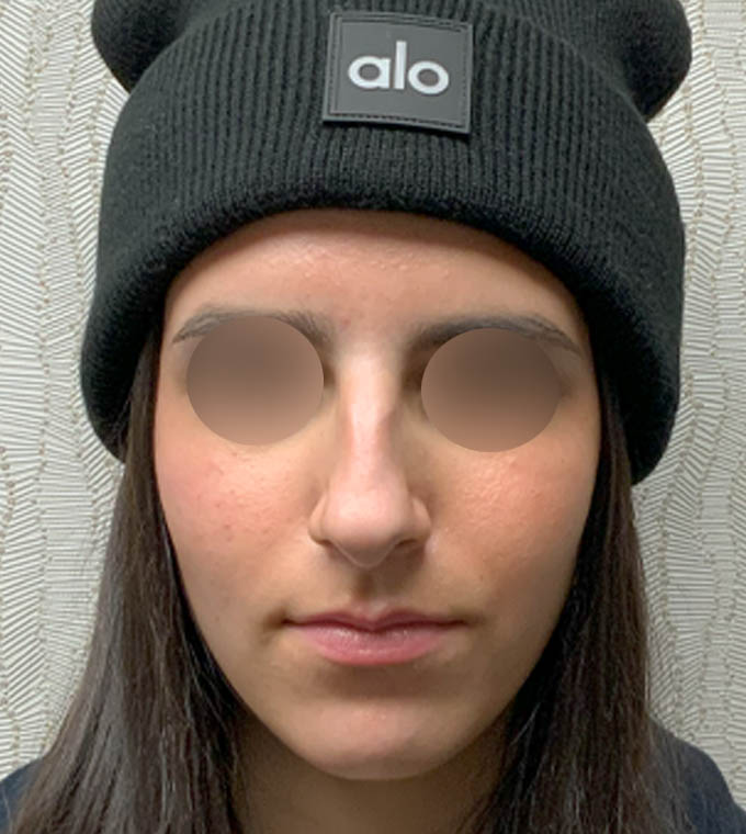Rhinoplasty