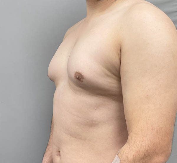 Gynecomastia
