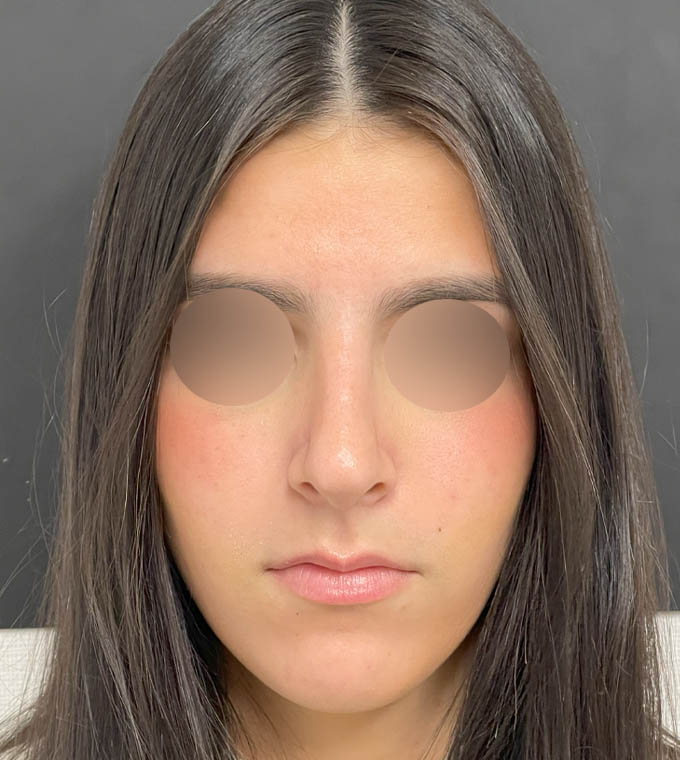 Rhinoplasty